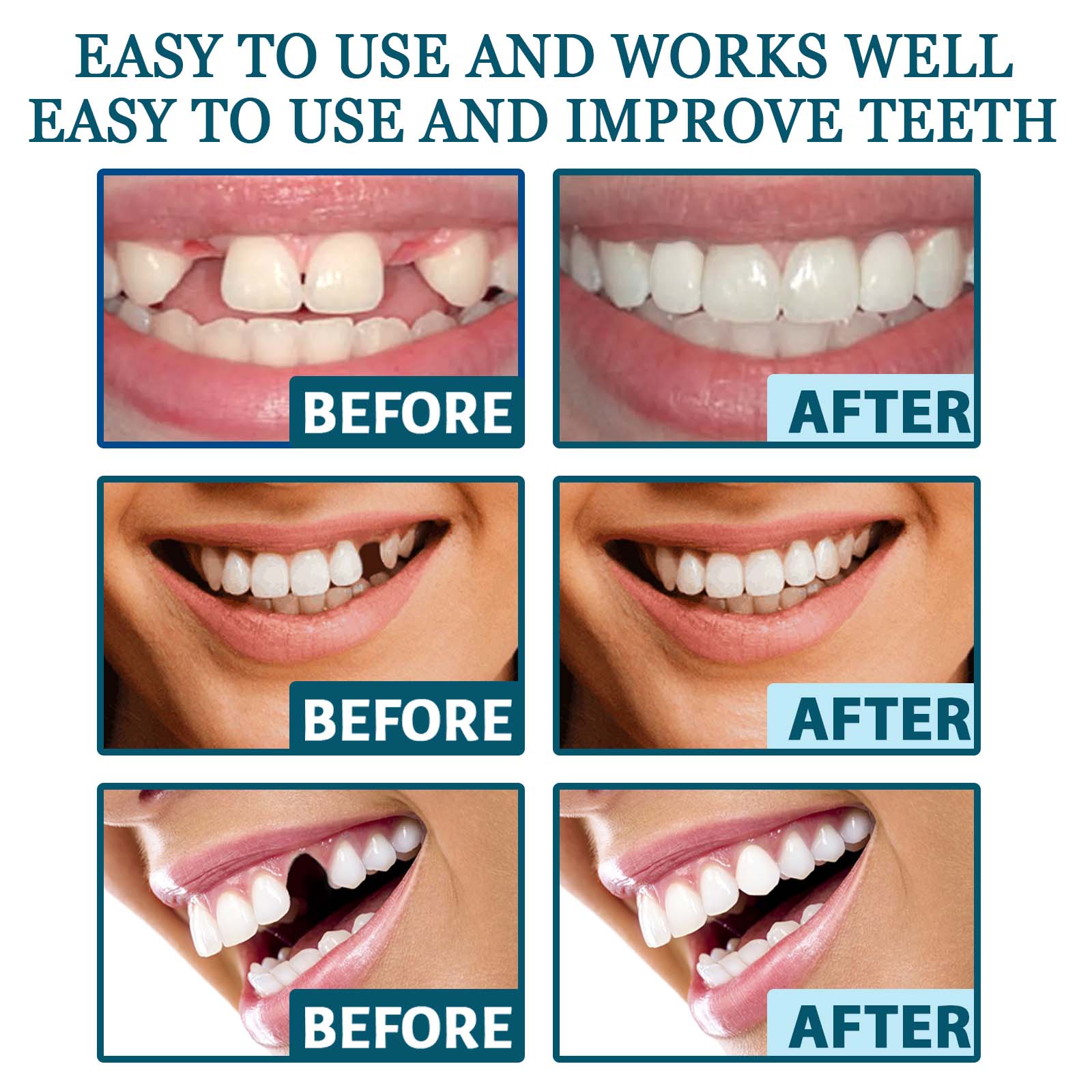 FlexSmile™ Dentures